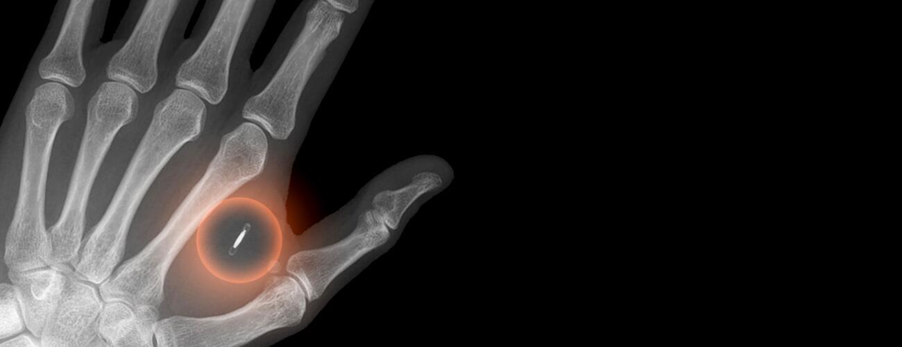 Darstellung einer Hand in Röntgenansicht, die einen Chip implantiert hat